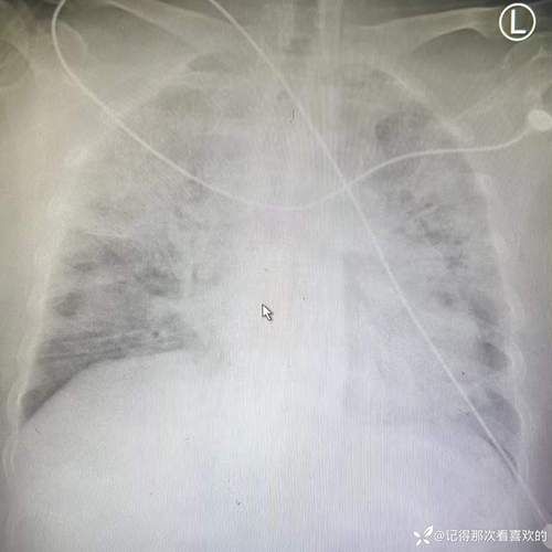多地增10例重症/9例重症患者